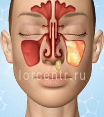 Az orrmelléküreg-gyulladás kezelésére Moszkva - ingyenes online orvos konzultáció