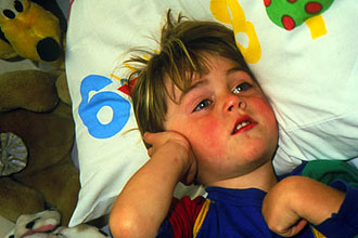 Gennyes középfülgyulladást gyermekek - tünetek és gyermekek kezelésére