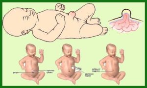 Sérv az újszülött tüneteket, kezelése és megelőzése