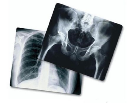 Milyen gyakran és hányszor lehet csinálni egy x-ray