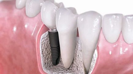 Mi implantátumok fogak jobban tenni a rágás fogak