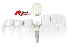 Mi jobb fogak implantátumok (implantátumok)