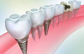 Mi jobb fogak implantátumok (implantátumok)