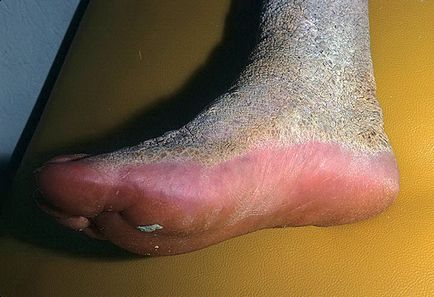 Hogyan működik a betegség ichthyosis harlekin