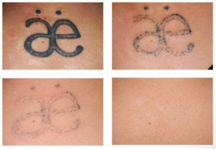 Hogyan készítsünk egy tetoválás otthon, hogy mit és hogyan lehet eltávolítani tetoválás