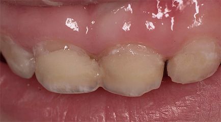 Hogyan védi a fogakat a fogszuvasodás, és megakadályozzák annak előfordulását