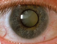 Lézeres látáskorrekció előnyeiről és hátrányairól műtét helyreállítási