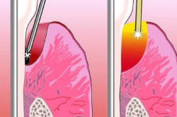Paradentózis gyógyítása lézer (lézeres kezelés periodontitis) Paradentózis gyógyítása lézeres