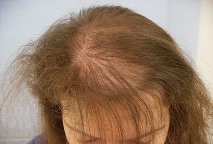 Folk jogorvoslati hajhullás nőknél az otthoni