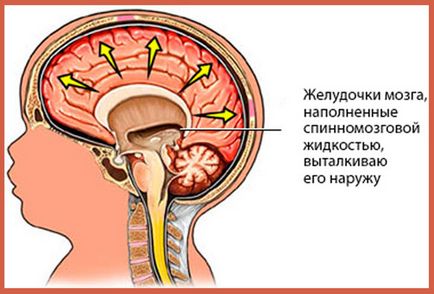 Külső hydrocephalus agy, ami, tünetei és kezelése