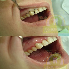 A periodontális betegség tüneteit, az ár a lézeres kezelés