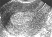 A patológia az endometrium ultrahang diagnosztika Nőgyógyászati ​​gyakorlatban
