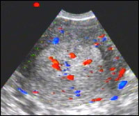 A patológia az endometrium ultrahang diagnosztika Nőgyógyászati ​​gyakorlatban