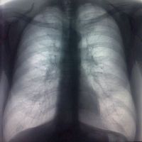 A tüdő-fibrózis - ami