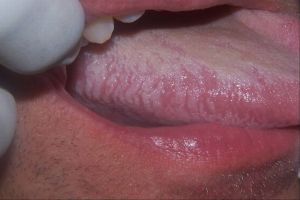 Miért karcos ég okok, diagnózis, hogyan nyugodt viszketés a száj