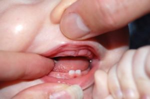 Miért egy gyerek nem nő fogak - késedelmet okoz kitörés