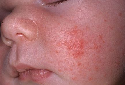 Sudamen arcán csecsemők okoz, tünetei, kezelés, megelőzés