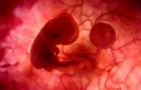 placenta previa