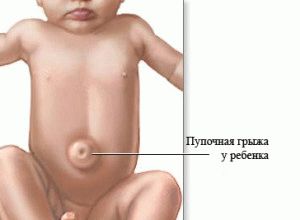 Köldöksérv csecsemők - a tüneteket, hogyan kell kezelni