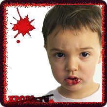 A gyermek tört az ajak - vérzések kezelését