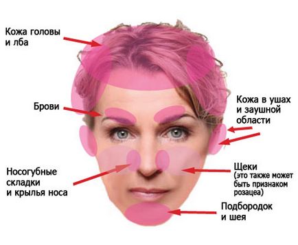 Seborrhoeás dermatitis az arcon az okok, tünetek, kezelés