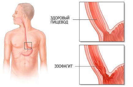 Tünetei és kezelése nyelőcső nyelőcső, prognózis és a diagnózis, diéta betegség