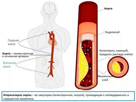 Sclerosis az aorta, amely, az okok, tünetek, kezelés