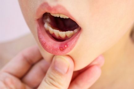 Stomatitis a gyermek okoz, típusok, mint kezelni