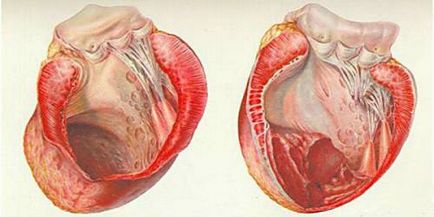 A vérrög a szív a tünetek és a kezelés, mit kell tenni, hogy ne jöjjön ki