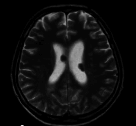 A sclerosis tuberosa tünetei és kezelése