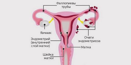 Uzi endometrium lehet látni, hogy az endometriózis, polipok, a rák, endometritis