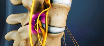 vertebrogenic cervicalgia