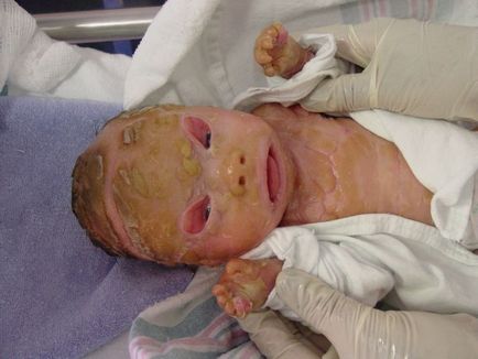 A túlélő a foltos ichthyosis (ichthyosis) Túlélni a harlekin ichthyosis