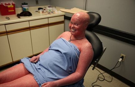 A túlélő a foltos ichthyosis (aktív élet) Túlélni a harlekin ichthyosis