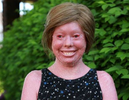 A túlélő a foltos ichthyosis (az aktív életmód) Túlélni a harlekin ichthyosis
