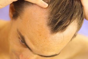 Hátráló hajszálrepedés homlokára férfiak 13 módon lehet megbirkózni a problémával