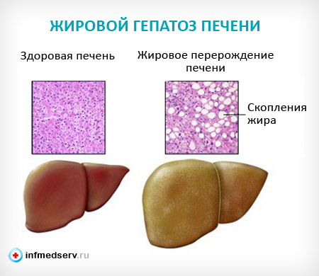 Steatosis okai és tünetei a máj