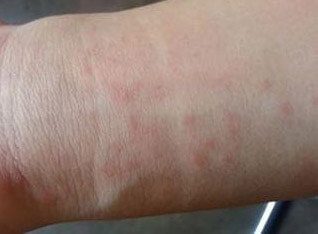 Allergiás a por (por allergia kezelésére) Allergia pornak