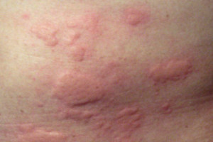 Allergiás a por - tünetek és kezelés