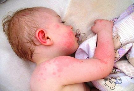 Allergiás a por gyermekek külleme, tünetek, kezelés