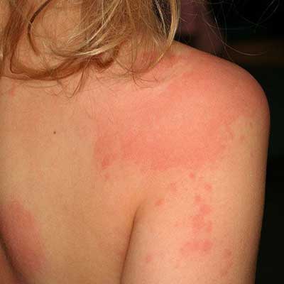 Allergia mosópor felnőttek és gyermekek - egy fotót az allergiás reakció