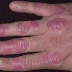 allergiás a víz a csapból okait és az allergia tüneteinek