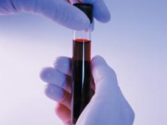 Elemzés a vér kreatinin diagnosztizálására használják betegségek