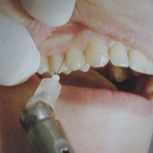 Fájdalomcsillapítás a fogorvosi variációk, javallatok, ellenjavallatok, modern