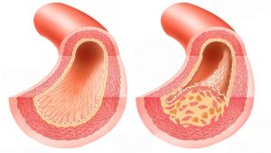 Atherosclerosis az alsó végtagok - tünetek és kezelés