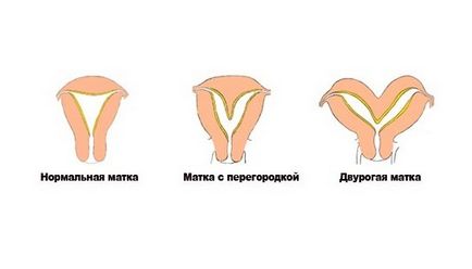 Terhesség a szeptum a méhben