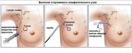 A biopszia és szerepe a diagnózis és a kezelés a rák