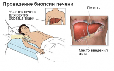 A biopszia és szerepe a diagnózis és a kezelés a rák