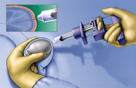 Biopsziás - módszer megerősítését rák bármely formáját