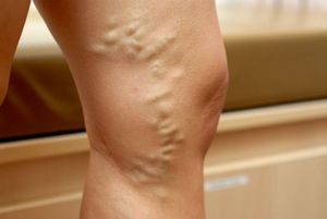 lábak érrendszeri betegség tünetei és a kezelés